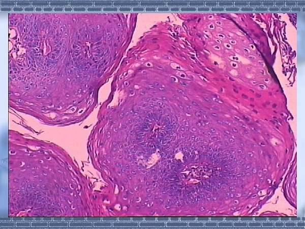 子宮內(nèi)膜異位的癥狀及治療方案(圖1) 梅州子宮內(nèi)膜異位的癥狀及治療方案(圖1)