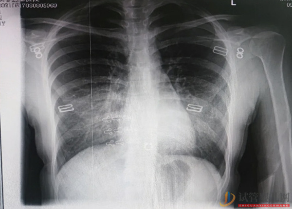 孕婦不能做胸透，一旦接觸了x光射線會導致寶寶畸形概率(圖2)