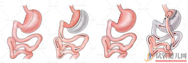 縮胃減肥還會(huì)影響生育?想懷孕的媽媽能不能做縮胃(單親媽媽能不能做試管嬰兒)多囊卵巢能懷上孩子嗎(圖2) 縮胃減肥還會(huì)影響生育?想懷孕的媽媽能不能做縮胃(圖1)
