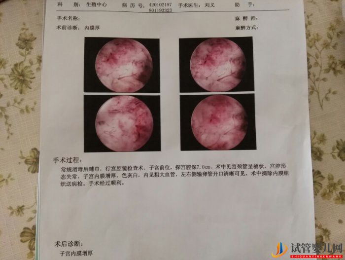 ?試管胚胎移植失敗后做宮腔鏡檢查有意義嗎？(圖1)