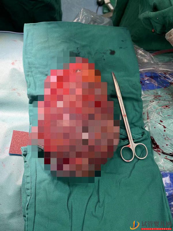 7斤2兩！女子高挺肚子像孕婦，醫生取出巨大腫瘤(圖2)