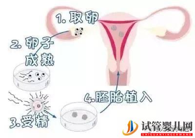 試管嬰兒的一個基本流程和周期時間(圖1) 試管嬰兒的一個基本流程和周期時間(圖1)