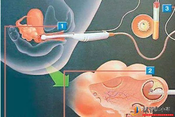 試管嬰兒基本流程(圖3)
