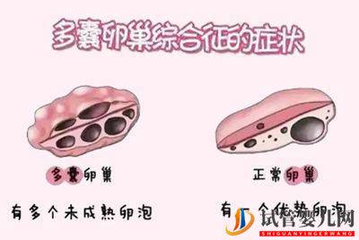 多囊做試管嬰兒要注意什么？(圖2)