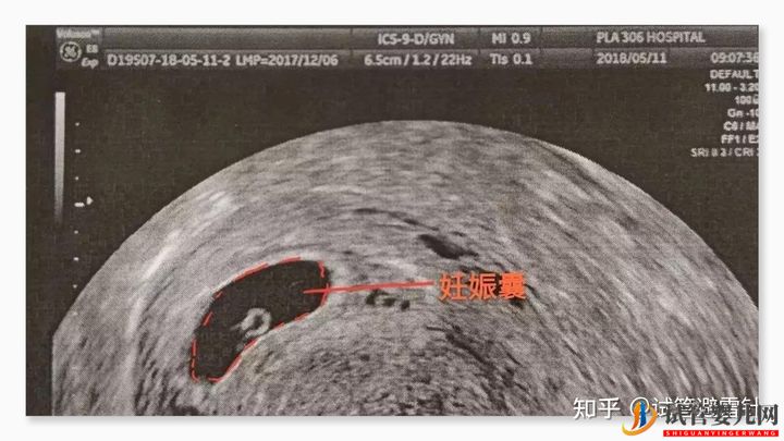 試管嬰兒網(wǎng):試管嬰兒費(fèi)用大約多少2022年——最全面的費(fèi)用詳解(圖2) 試管嬰兒費(fèi)用大約多少——最全面的費(fèi)用詳解(圖2)