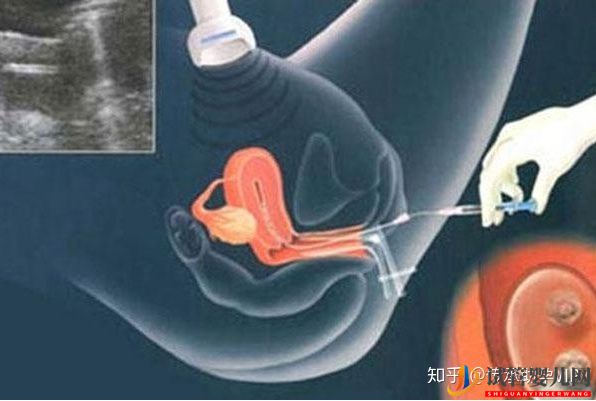 烏海試管嬰兒全過程需要多少時間(圖1)