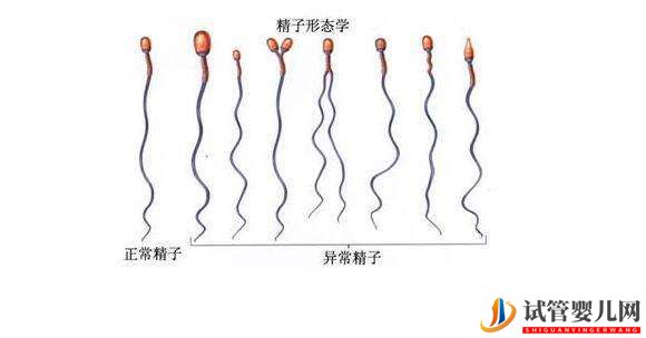 格魯吉亞試管嬰兒精子畸形可以做試管嬰兒嗎？(圖1)