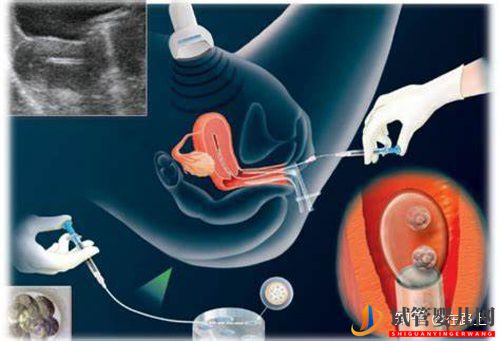 探索美國試管嬰兒費用清單(圖1)