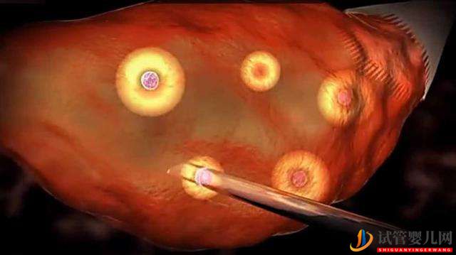 美國試管嬰兒取卵后女性感到惡心,是正常現(xiàn)象嗎_(圖1) 美國試管嬰兒取卵后女性感到惡心,是正常現(xiàn)象嗎(圖1)