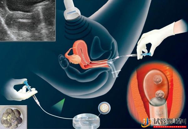 詳解美國第三代試管嬰兒流程(圖8)