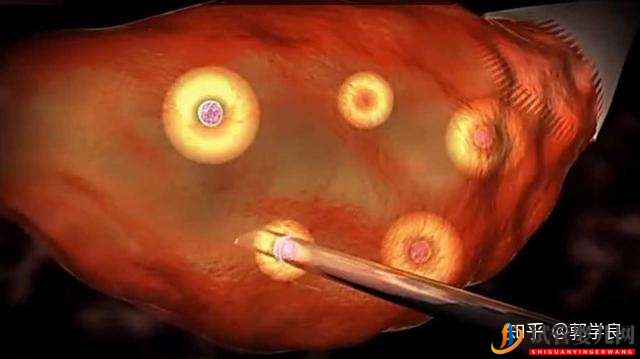 美國試管嬰兒方案制定依據各環節具體操作及重點(圖6)