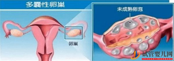 多囊卵巢綜合征對試管嬰兒成功率有哪些影響_如何及時調理(圖1)