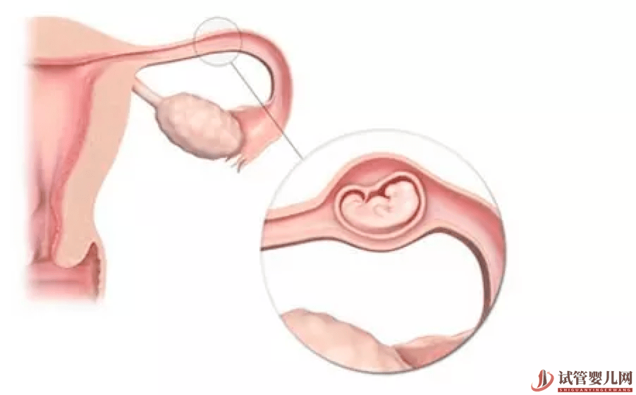 做試管嬰兒是不是可以避免宮外孕了？醫生告訴你沒那么簡單！(圖1)