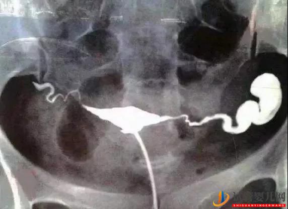 南昌輸卵管積水“切”還是“留”？自然懷孕or試管嬰兒該如何選？(圖1)