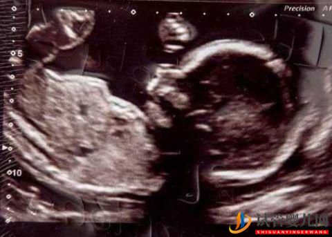 試管嬰兒網(wǎng):48歲女子努力懷孕23年不成,借高利貸做試管嬰成功,稱不后悔(圖3) 48歲女子努力懷孕23年不成,借高利貸做試管嬰成功,稱不后悔(圖2)