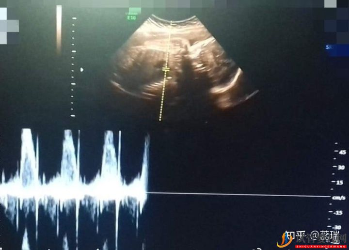 我終于懷上了!辛酸三代試管經(jīng)歷!大家接好孕!(圖2)