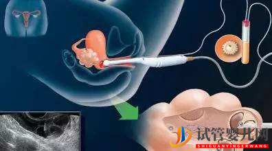 試管嬰兒網(wǎng):移植囊胚后可以喝蜂蜜水嗎?取卵后可以喝蜂蜜嗎?(圖2) 移植囊胚后可以喝蜂蜜水嗎?取卵后可以喝蜂蜜嗎?(圖1)