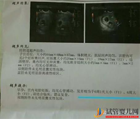 試管嬰兒網(wǎng):一個高齡婦女的試管之路(三次取卵兩次移植的龍鳳胎...(圖7) 一個高齡婦女的試管之路(圖4)