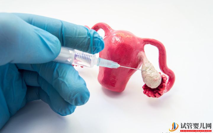 如何治療好多囊卵巢綜合癥一般通過以下3種方式可治(圖1)