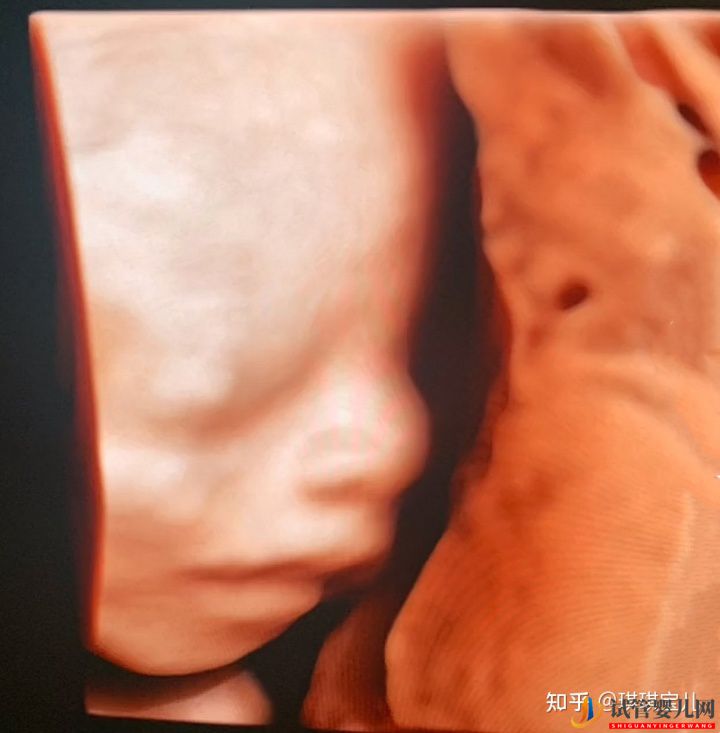 試管一次性成功,喜迎雙胎超順利(圖5)