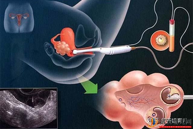 國內首例“試管嬰兒”,如今已32歲,生活狀況在眾人...(圖7)