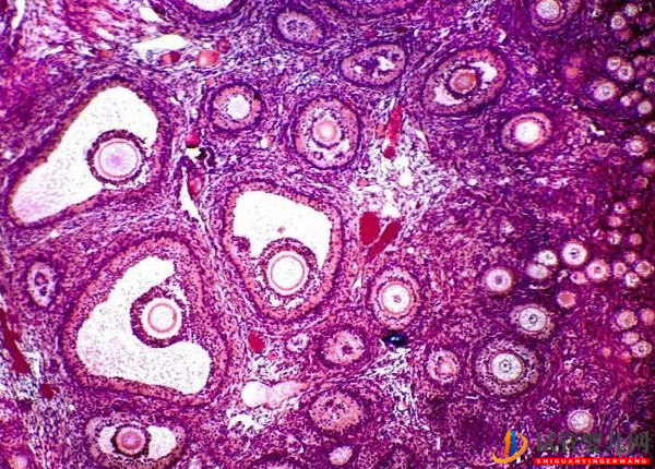 試管嬰兒網(wǎng):多囊、早衰都不是!這才是21個(gè)基礎(chǔ)卵泡降調(diào)變10個(gè)的原因(圖2) 多囊、早衰都不是!這才是21個(gè)基礎(chǔ)卵泡降調(diào)變10個(gè)的原因(圖2)