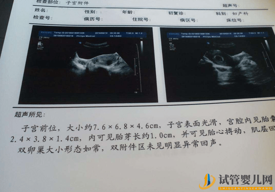 試管移植41天查不出胎心胎芽？謹(jǐn)防胎停育！(圖1)