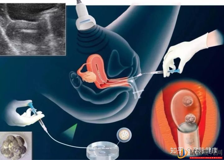 中美試管嬰兒的差異在哪里(圖2)