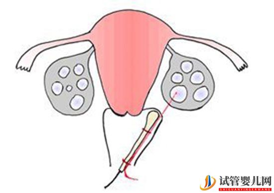 泰國試管嬰兒流程詳細分享!(圖2)