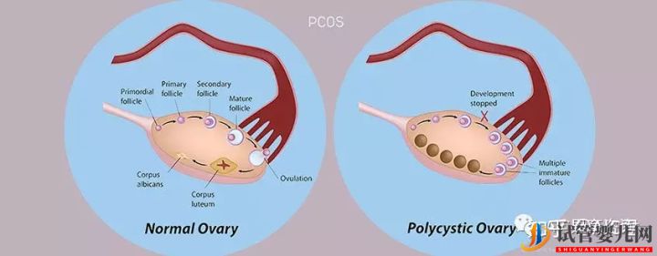 美國試管嬰兒究竟適合哪幾類人群(圖2)