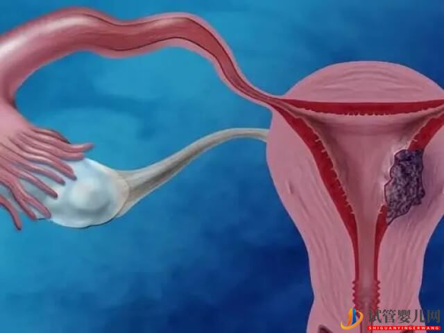 巧克力囊腫做試管移植一次就成功的概率高嗎？(圖1)