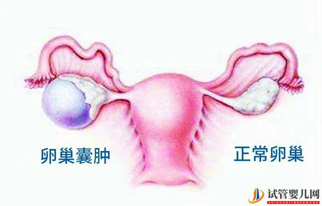 有卵巢囊腫可以做試管嬰兒?jiǎn)幔?圖1)