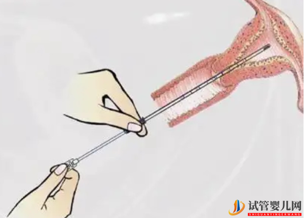 做試管并非人人都要刮宮(圖1)
