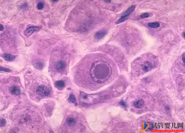 解脲脲支原體陽性不能做試管(圖1)