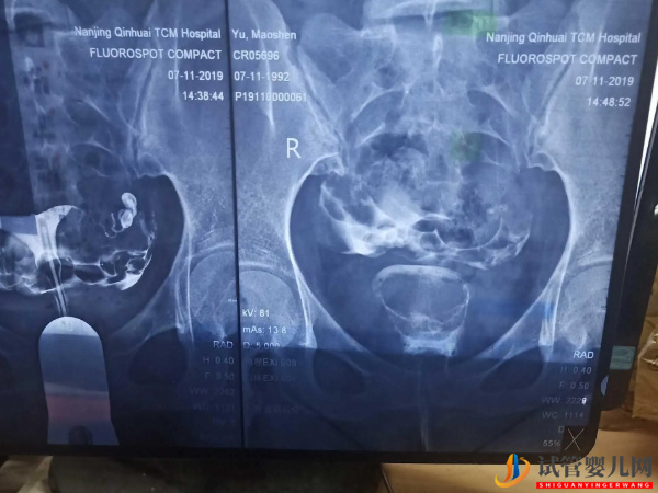 盆腔粘連別直接做試管嬰兒，手術分粘是治療第一步(圖1)