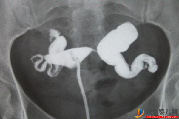 兩側(cè)輸卵管都切除了還能做試管？(圖2)