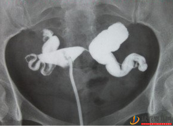 輸卵管積水做試管有明顯影響，要不要切除有兩種情況(圖2)