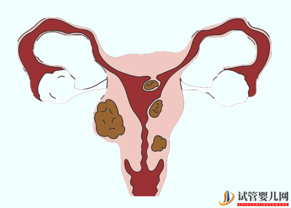 子宮肌瘤做試管成功率不高(圖1)