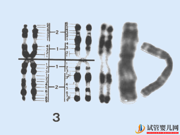 3號染色體異常會怎樣 - 基因微缺失、微重復相關(guān)病癥導航(圖1) 3號染色體異常會怎樣 - 基因微缺失、微重復相關(guān)病癥導航(圖1)