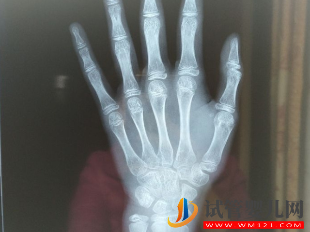 10-16歲兒童正常骨齡與身高對照表，免費了解孩子生長潛力(圖1)