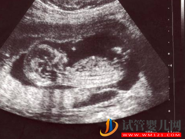 四維彩超數(shù)據(jù)和圖片看男女超準(zhǔn),這些看男女小技巧全教給你(圖1) 四維彩超數(shù)據(jù)和圖片看男女超準(zhǔn),這些看男女小技巧全教給你(圖1)