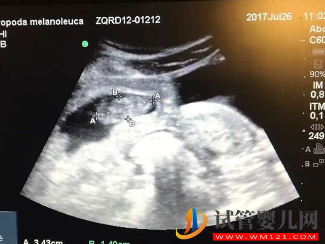 四維彩超數(shù)據(jù)和圖片看男女超準(zhǔn),這些看男女小技巧全教給你(圖2) 四維彩超數(shù)據(jù)和圖片看男女超準(zhǔn),這些看男女小技巧全教給你(圖2)