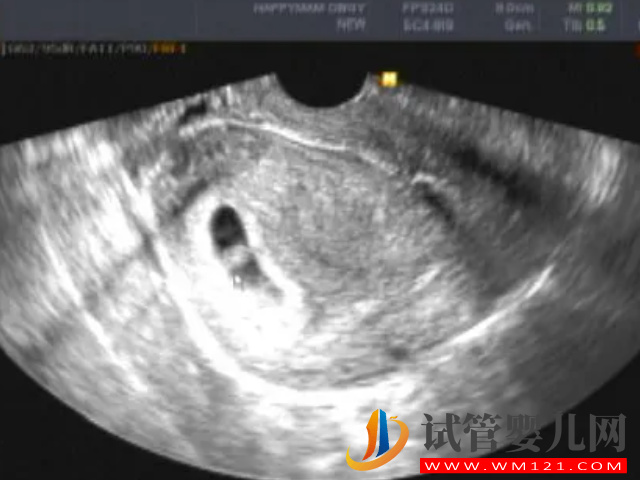 孕囊大小與孕周正常對照表,50天孕囊在范圍就無須擔心(圖1) 孕囊大小與孕周正常對照表,50天孕囊在范圍就無須擔心(圖1)