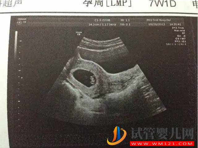 孕囊大小與孕周正常對照表,50天孕囊在范圍就無須擔心(圖3) 孕囊大小與孕周正常對照表,50天孕囊在范圍就無須擔心(圖3)