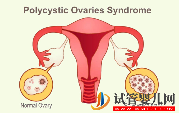 多囊卵巢服用維生素E的正確吃法:從月經(jīng)期開始對身體有好處(圖1) 多囊卵巢服用維生素E的正確吃法:從月經(jīng)期開始對身體有好處(圖1)