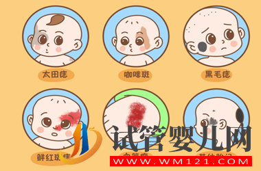 胎記遺傳的可能性大嗎?試管嬰兒會長胎記嗎?(圖2)