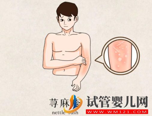 蕁麻疹會遺傳下一代嗎，蕁麻疹能通過試管根治嗎？(圖1)