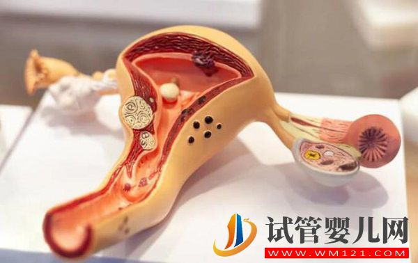 子宮腺肌癥射頻治療效果不佳，中醫+飲食調理可能更好(圖2)