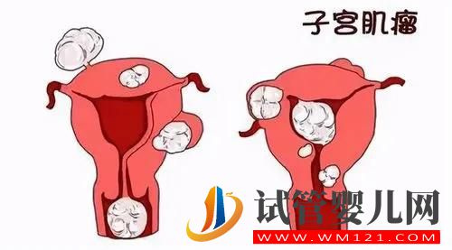 什么是子宮肌瘤?(圖1) 什么是子宮肌瘤?(圖1)
