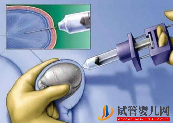 男性不孕隱蔽問題,精子DNA斷裂怎么辦?(圖2) 男性不孕隱蔽問題,精子DNA斷裂怎么辦?(圖2)